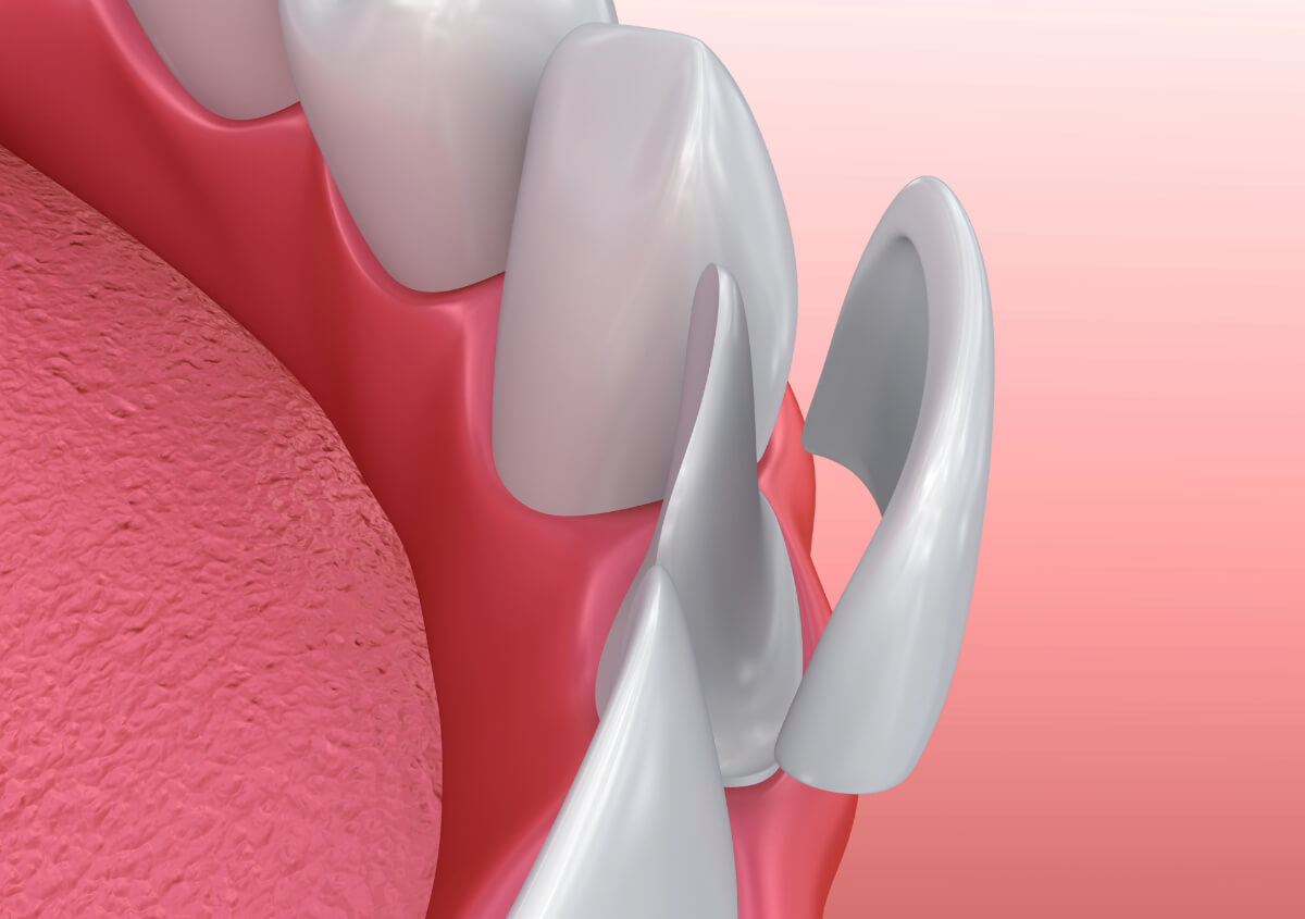 Is dental bonding as good as porcelain veneers?