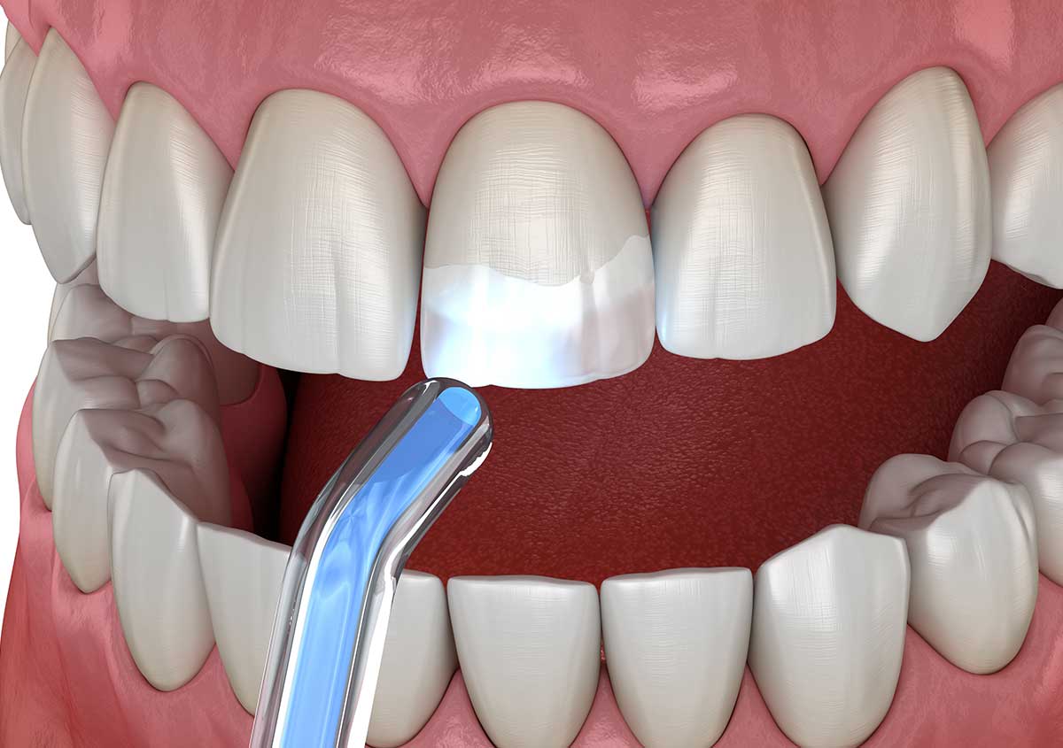 What to Expect During Cavity Treatment with Composite Fillings