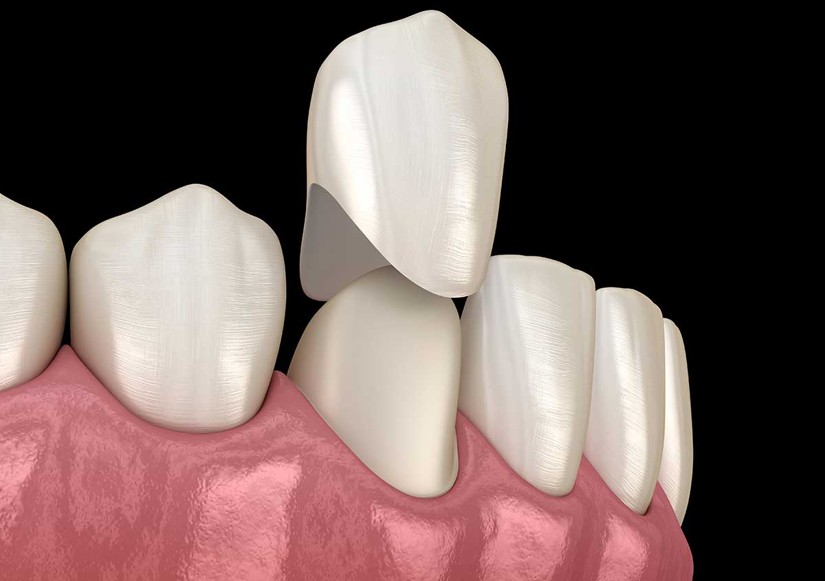 Restore Your Smile and Oral Health with Versatile Porcelain Dental Crowns