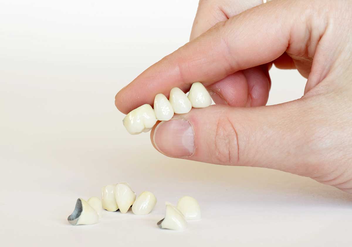 Dental Bridge, A Functional and Aesthetically Pleasing Tooth Restoring Treatment